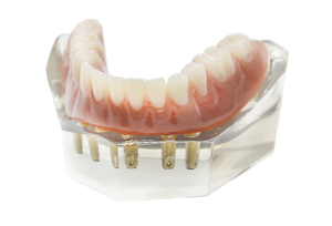 implants Clinique de denturologie Solutions Sourire Stefka popova