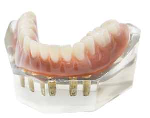 prothèse sur implants Clinique de Denturologie Solutions Sourires Stefka Popova Prothèses sur implants dentaires